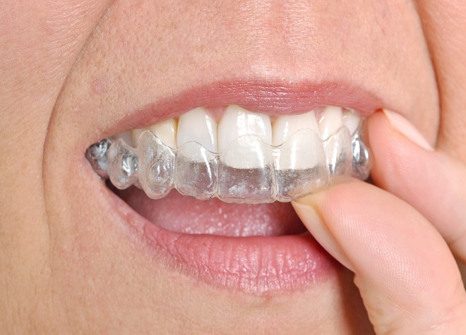 プライム総合歯科クリニック_治療中でも装置が目立ちにくいマウスピース矯正をご提案することも可能