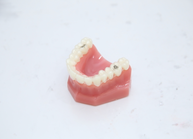 平川歯科クリニック_矯正治療中の見た目にも配慮したマウスピース矯正で、抜歯のリスクを軽減