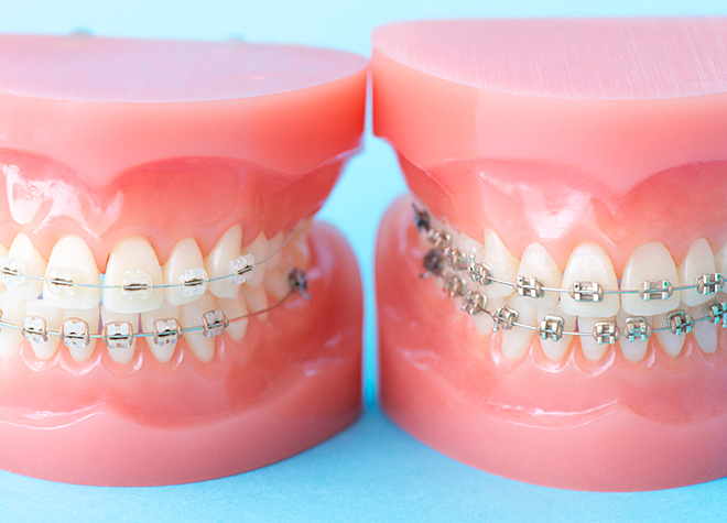 デンタルクリニック・ヒロ_ワイヤー矯正で細かなアプローチにも対応。前歯の傾斜にもアプローチできます