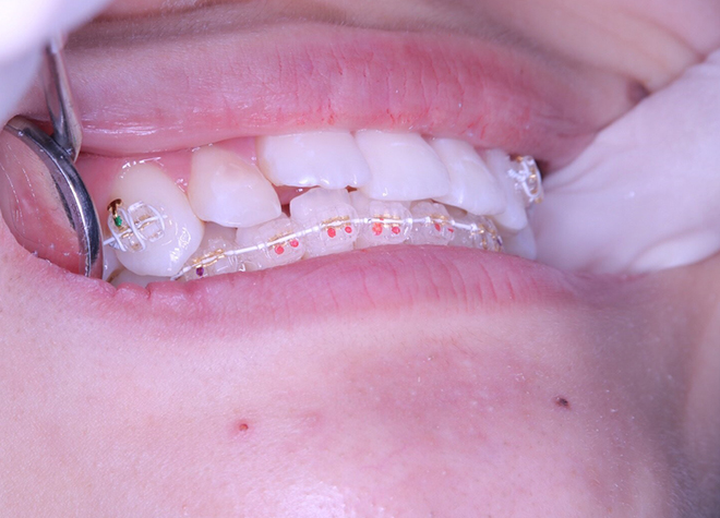 おおたメディカルモール歯科_着脱も可能なマウスピース矯正は、歯磨きやお食事も普段通りおこなうことができます